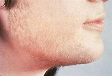 ریش هایی که با رسیدن بلوغ به رشد کامل نمی رسند