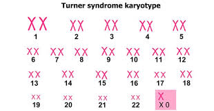 سندرم ترنر و اطلاعات مفیدی درخصوص این عارضه