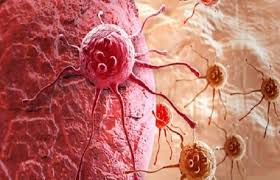 سرطان آندومتر نوعی سرطان مختص به بانوان