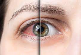 خشکی چشم به چه دلایلی ایجاد می شود ؟
